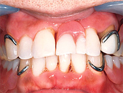 金属のバネのある入れ歯