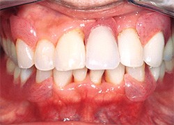 金属のバネの無い入れ歯