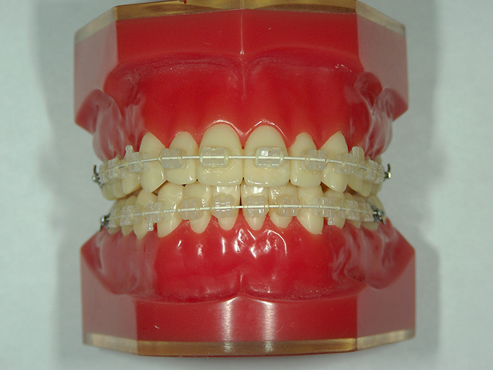 ブラケット矯正装置（セラミック製）