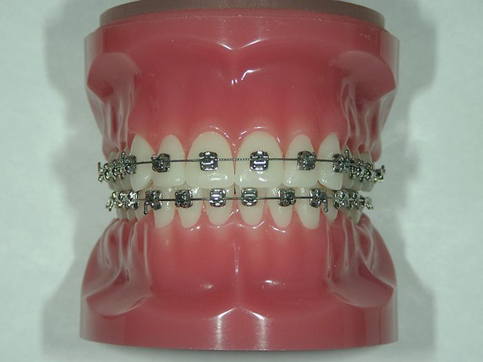 セルフライゲーションブラケット装置（エンパワー）