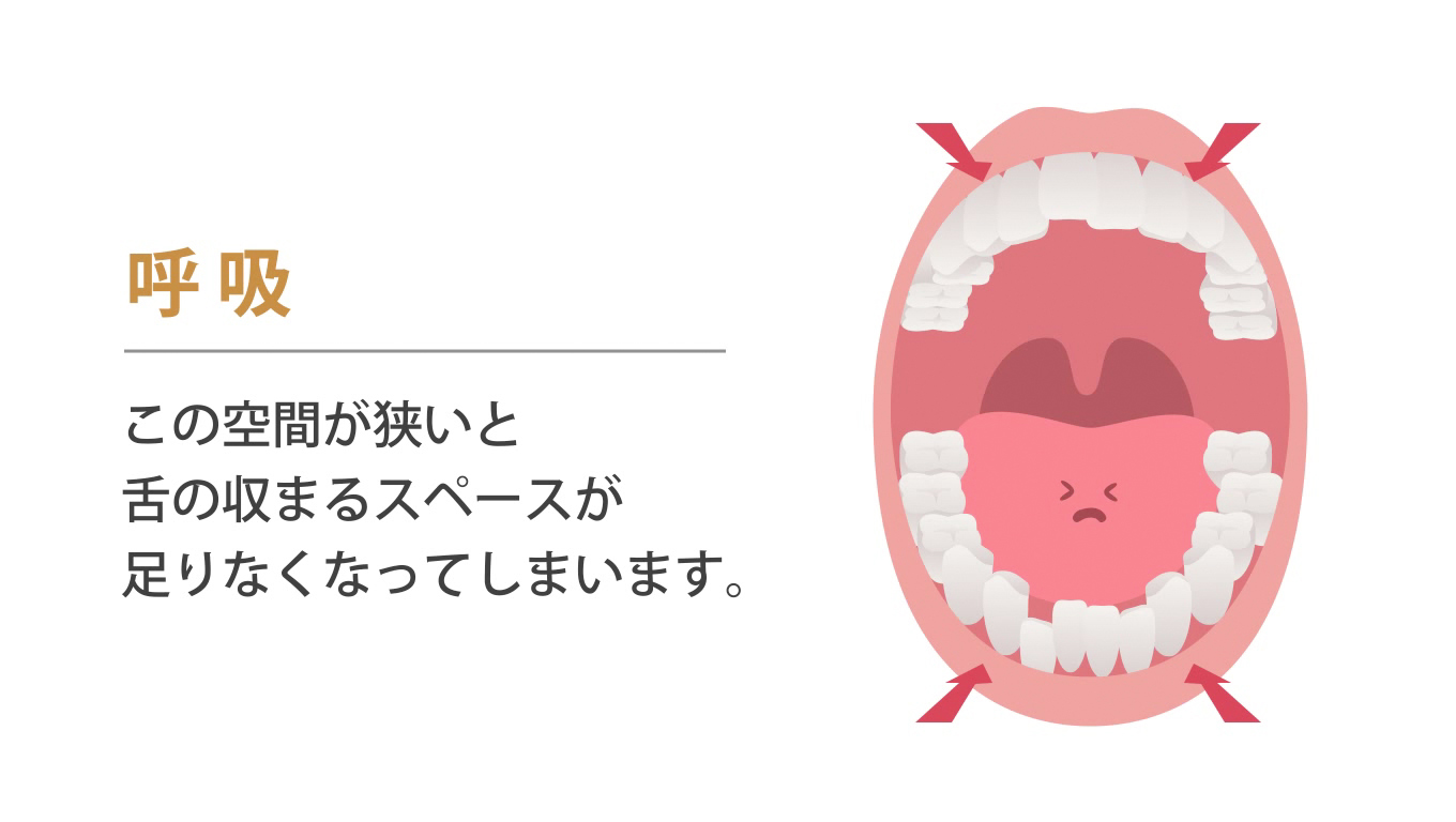 歯科矯正ランパ療法14