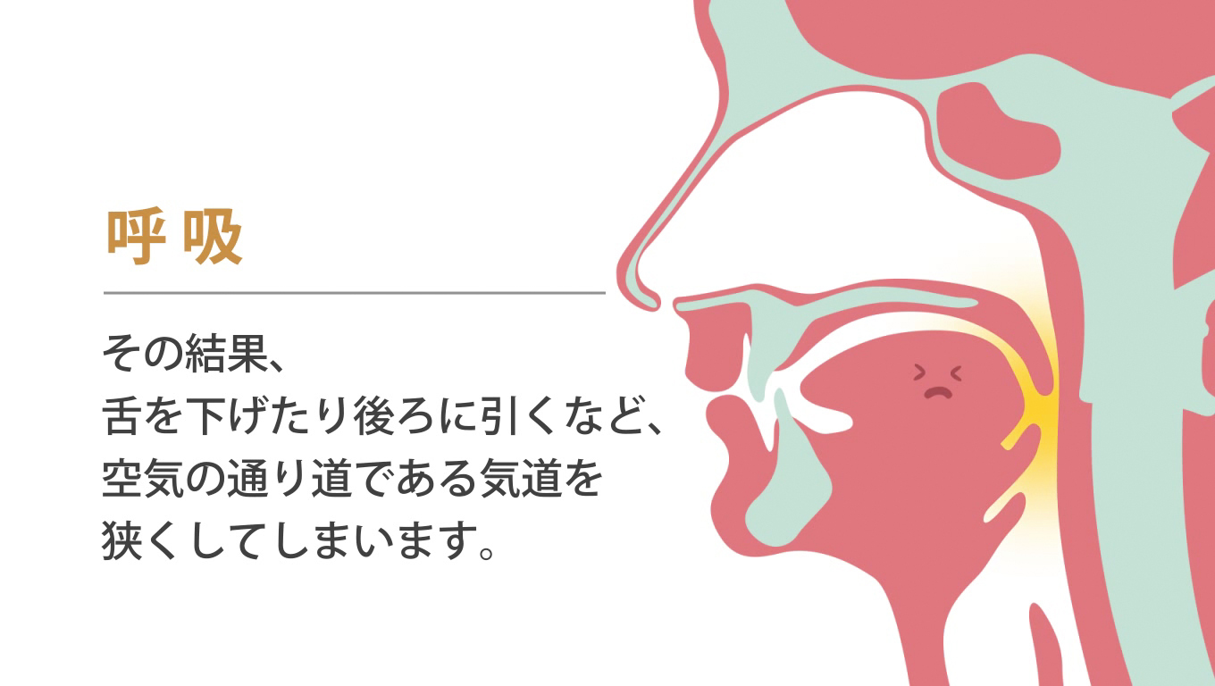 歯科矯正ランパ療法16