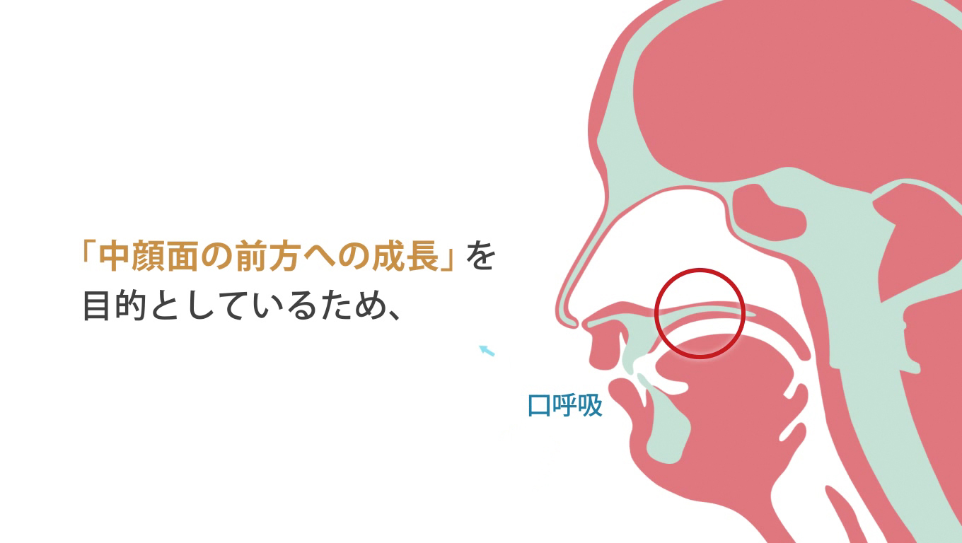 歯科矯正ランパ療法20