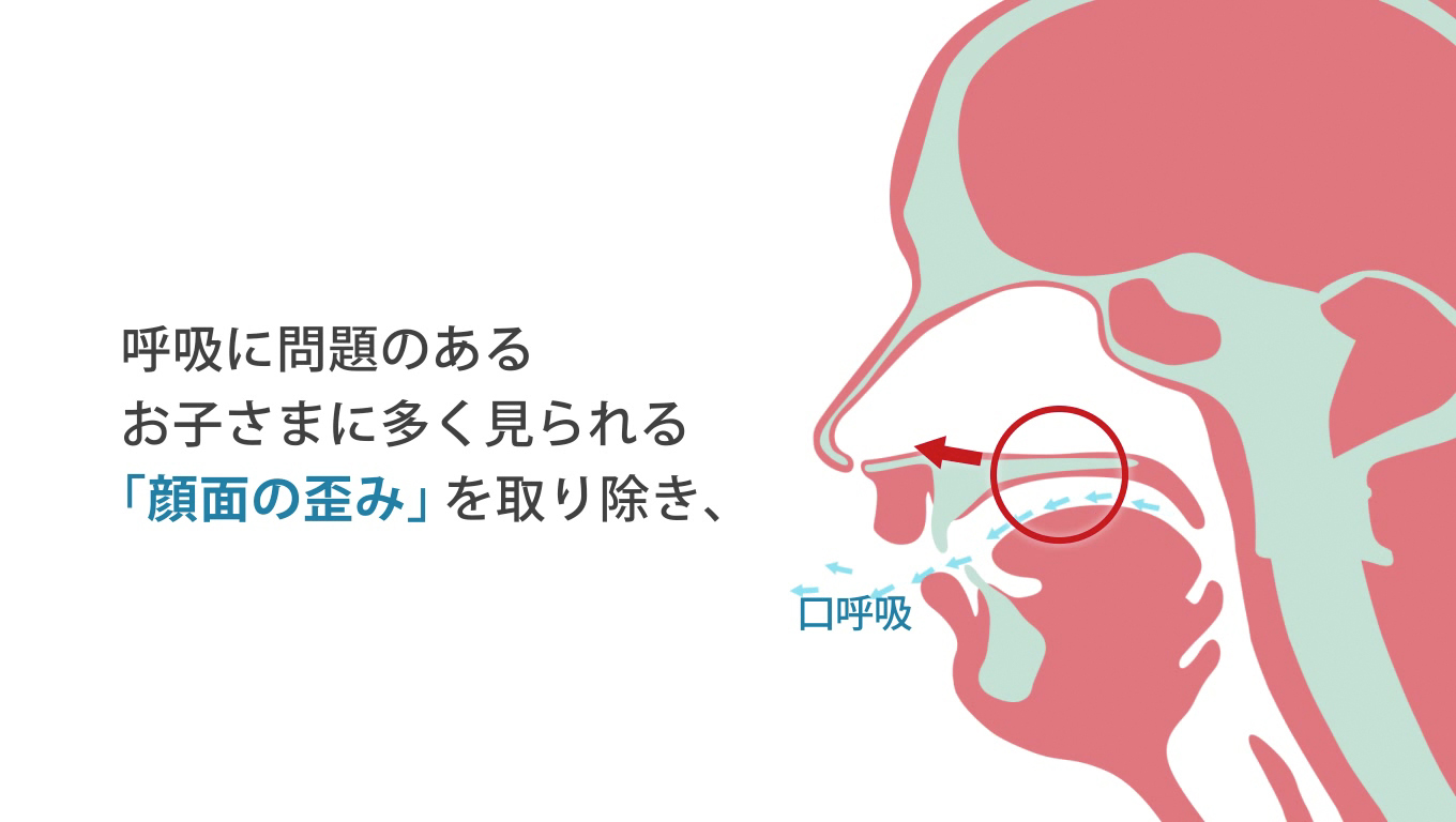 歯科矯正ランパ療法21