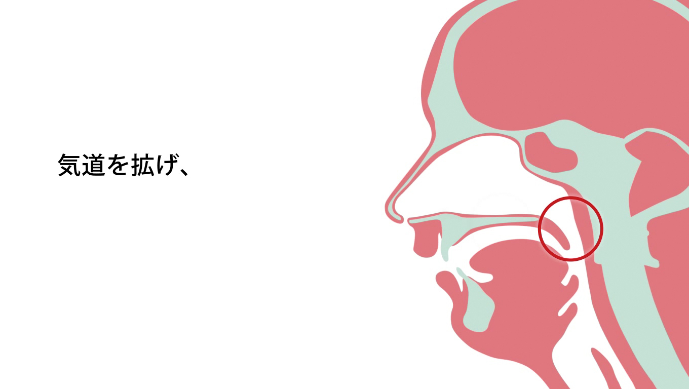 歯科矯正ランパ療法22