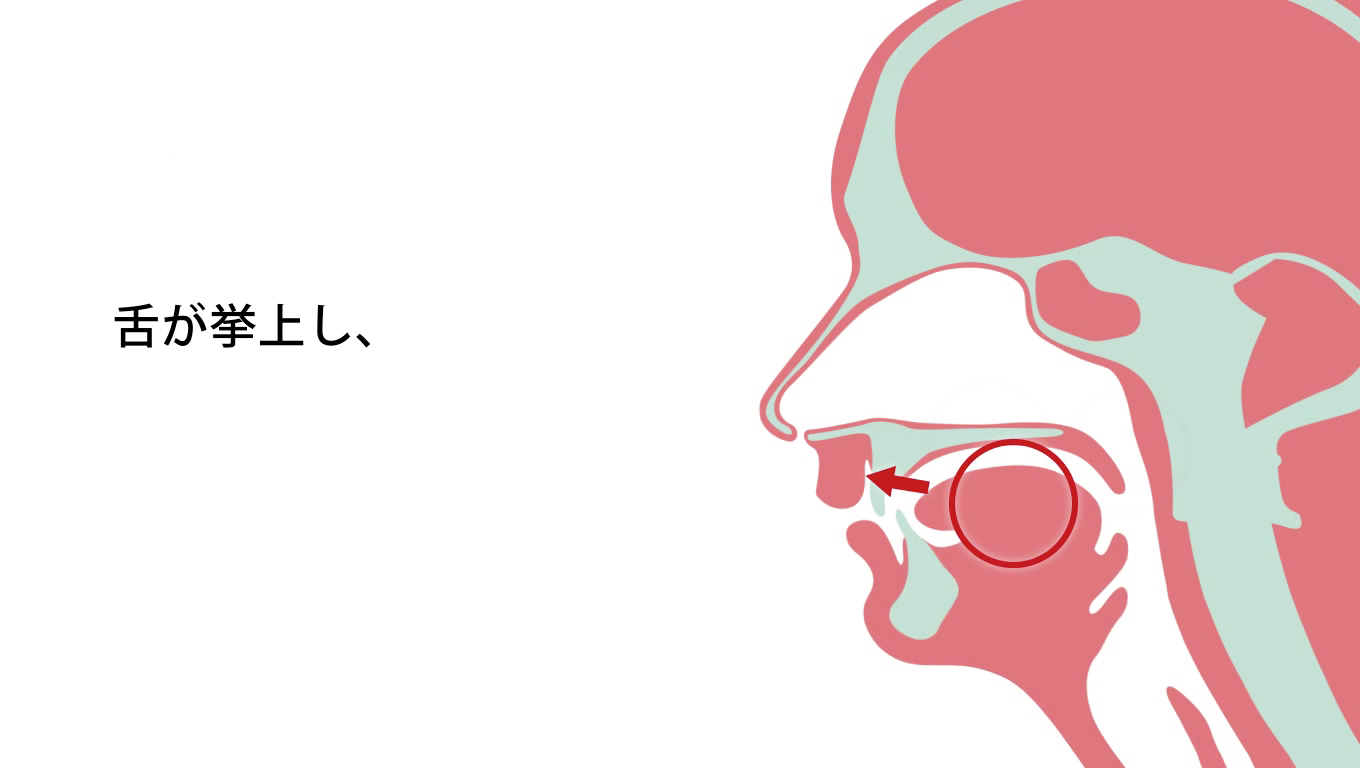 歯科矯正ランパ療法23