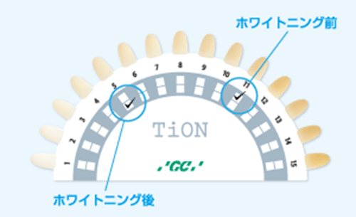 ホワイトニングの確認