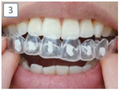 ホームホワイトニングステップ3